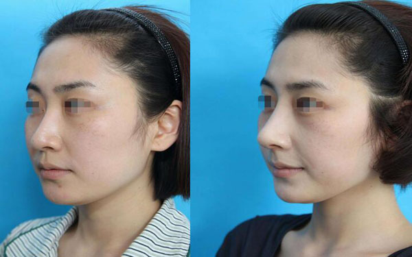 做鼻中隔軟骨墊鼻尖調(diào)節(jié)果怎么樣?果保持時間多久?