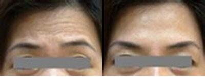 做電波拉皮去法令紋調(diào)節(jié)果怎么樣?果保持時(shí)間多久?