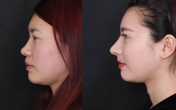 做硅膠延長鼻小柱調(diào)節(jié)果怎么樣?果保持時間多久?