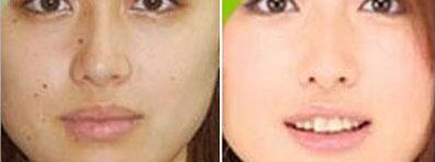 做微晶磨削點(diǎn)痣調(diào)節(jié)果怎么樣?果保持時(shí)間多久?