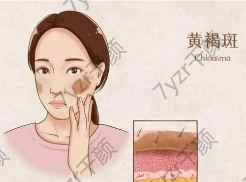 激光祛斑后反黑需要多長(zhǎng)時(shí)間恢復(fù)