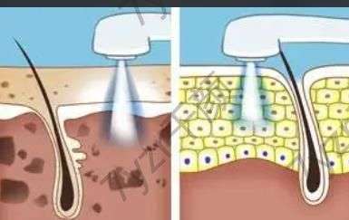 激光美白的優(yōu)勢有哪些，能維持多久