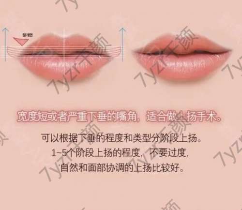 嘴角上揚手術(shù)會留疤嗎，切口在哪個位置?