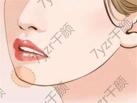 玻尿酸墊下巴后怎么護(hù)理對恢復(fù)有好處呢？