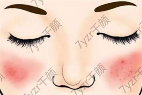 激光去紅血絲疼嗎？激光去除紅血絲后怎么護理?