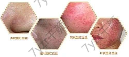 用激光清除紅血絲是不是的呢？注意事項有哪些?