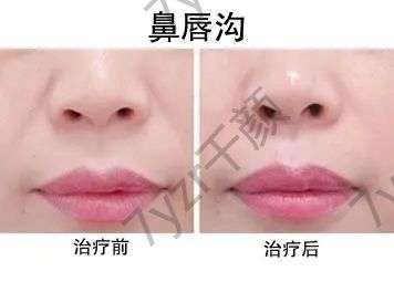 自體脂肪填充鼻唇溝有什么優(yōu)勢?果好不好?