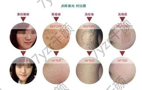 激光祛痘的原理是什么，有哪些需要注意？