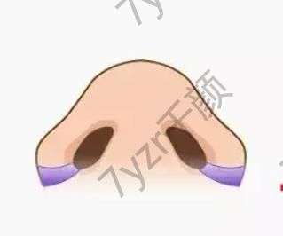 鼻翼縮小有什么風險，會影響呼吸嗎