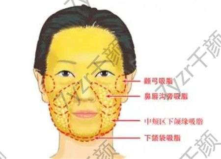 面部吸脂有沒有危險(xiǎn)，有哪些危害