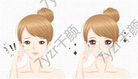 雙眼皮手術(shù)有什么后遺癥，怎么護(hù)理