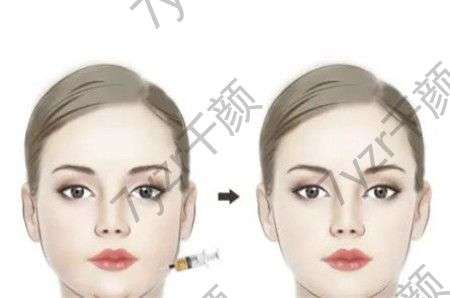 頰脂墊去除適合哪些人?要注意什么