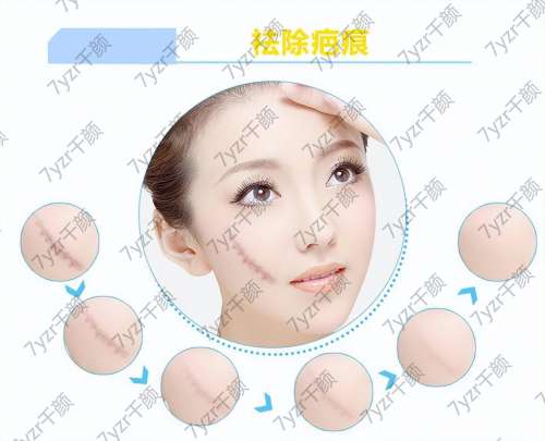 激光如何去除疤痕的?不適合激光祛疤的7種情況