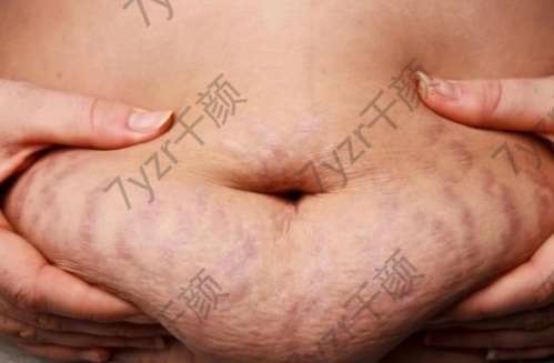 皮膚瘢痕小科普，祛疤方案知幾何？