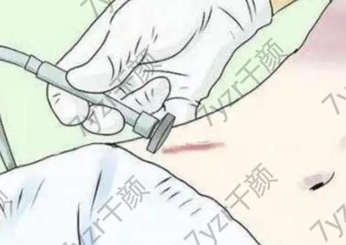 生姜片涂抹能祛疤？專家提醒：這些“民間處方”莫信