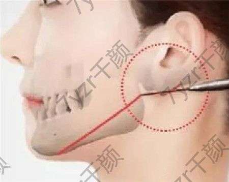 顴骨整形手術(shù)的副作用與哪些因素有關(guān)?