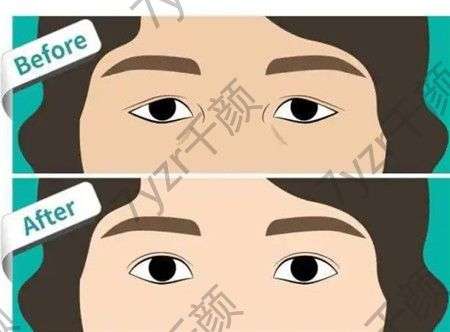 雙眼皮手術(shù)什么時候做好?