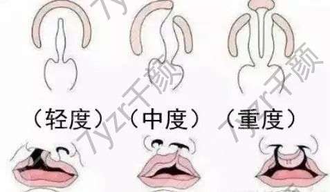 唇裂修復(fù)術(shù)后多久才能恢復(fù)正常？