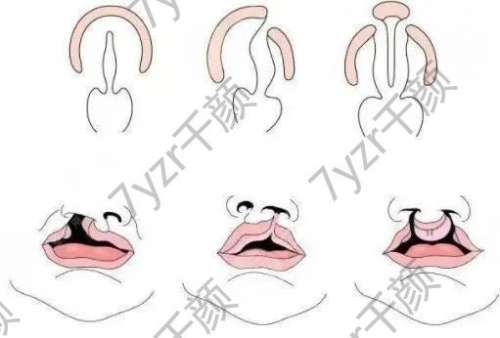 唇腭裂與唇裂修復(fù)有什么不同？