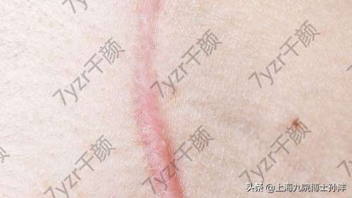 激光祛疤能去除什么樣的疤痕，幾次能做到?jīng)]有痕跡呢？