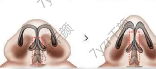 鼻小柱延長(zhǎng)有后遺癥嗎，后遺癥有哪些?