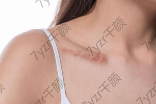 醫(yī)生揭秘：身上留了難看的瘢痕怎么辦？