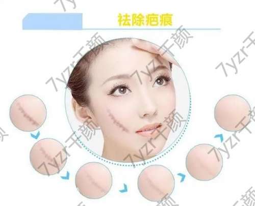 什么是激光除疤，激光除疤適合哪些人？