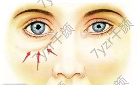 漲知識(shí)|淚溝填充——不是打一針那么簡(jiǎn)單!