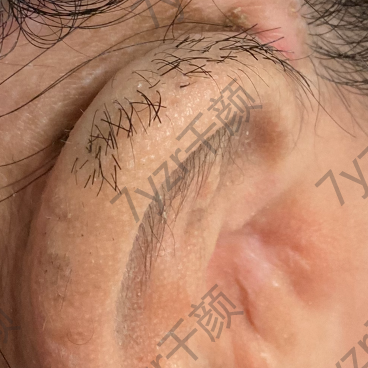 耳再造術(shù)前為什么要脫毛?