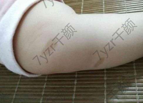 激光去胎記會影響健康嗎？孩子年紀太小能不能做？