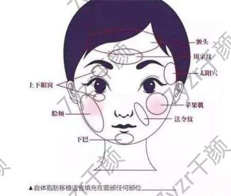 自體脂肪填充淚溝的注意事項有哪些