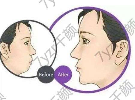 下巴整形手術的方法有哪些