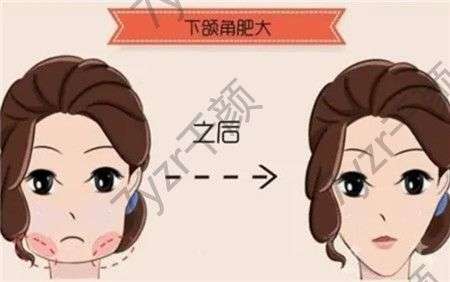 下頜角整形怎么樣，有什么優(yōu)點(diǎn)？