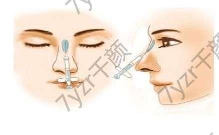 耳軟骨墊鼻尖有什么好處，需要多少錢