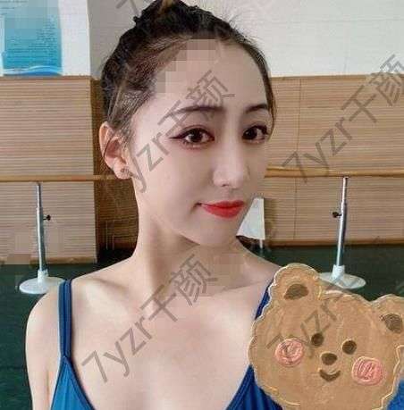 做完激光祛眼袋手術(shù)已經(jīng)有一周的時(shí)間了