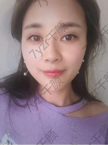 大秋冬季節(jié)水光針真的太拯救我的皮膚