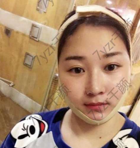 剛打完瘦臉針的這幾天效果還是沒有出來