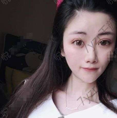 不知不覺做去眼袋的手術(shù)已經(jīng)過去半個(gè)月了