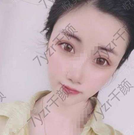 沒有眼袋了之后確實(shí)讓整個(gè)人特別的減齡