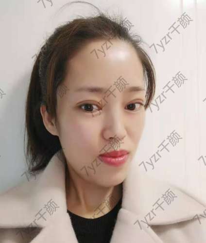 一直想做雙眼皮手術(shù)，因?yàn)檠劬φ娴暮苡绊懳业拿嬷?></a>
								</div>
								<div   id=