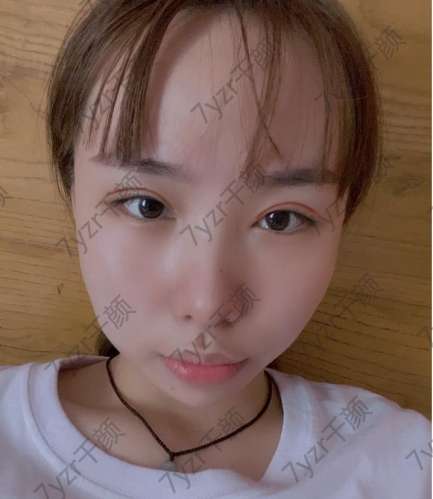 終于有雙眼皮了今天是做完雙眼皮的第一天