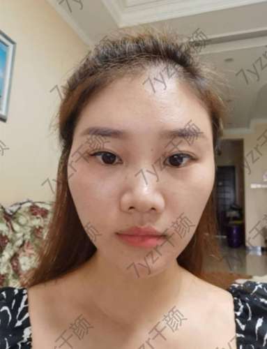 埋線雙眼皮手術(shù)后兩個月今天我化了一個漂亮的妝