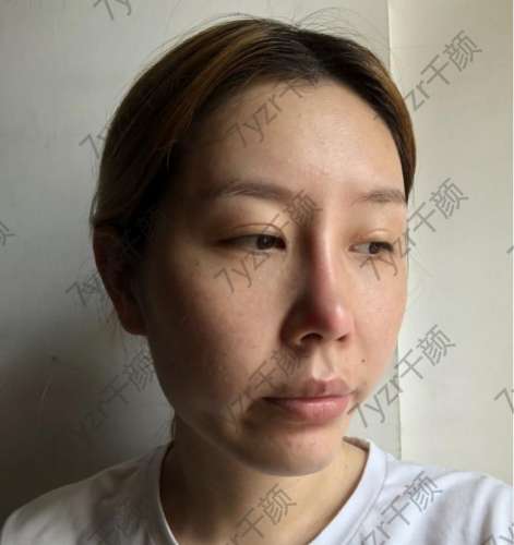 目前鼻子沒有不適側(cè)視圖很滿意