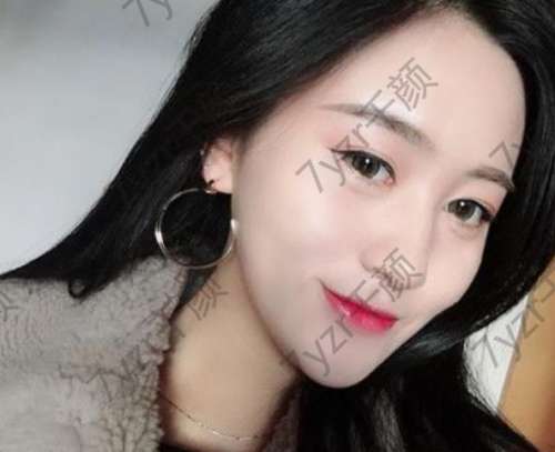 切開雙眼皮手術(shù)后3個月現(xiàn)在正常上班沒什么問題