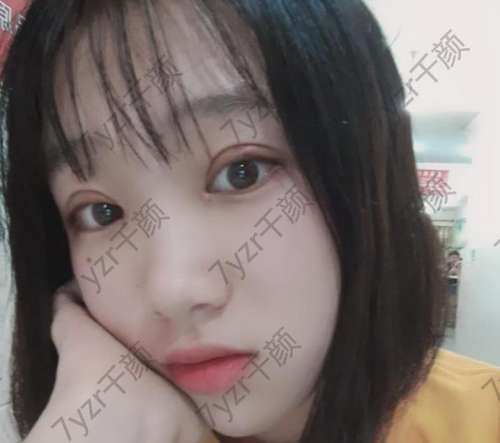 雙眼皮手術(shù)是局部麻醉