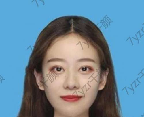 先說(shuō)說(shuō)我為什么要做雙眼皮?