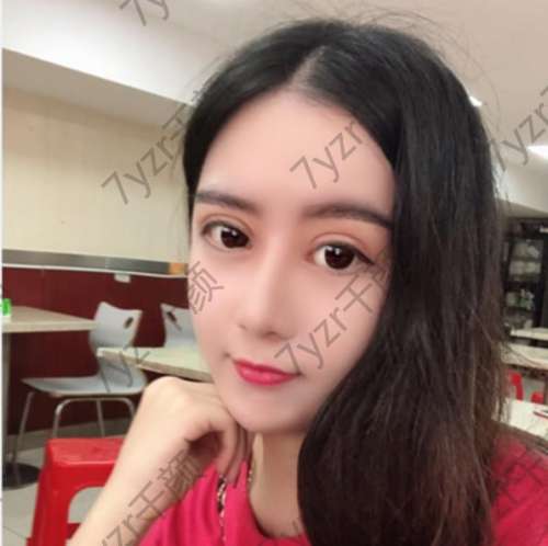 切開雙眼皮手術(shù)后兩個月