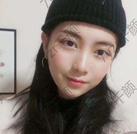 隆鼻拆線前不要沾水，不要吃辛辣食物