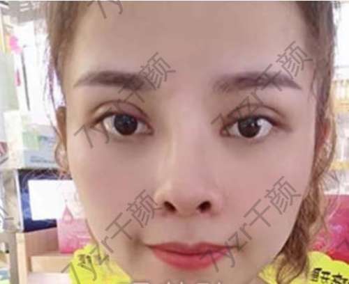 決定完全擁有一雙屬于自己的雙眼皮