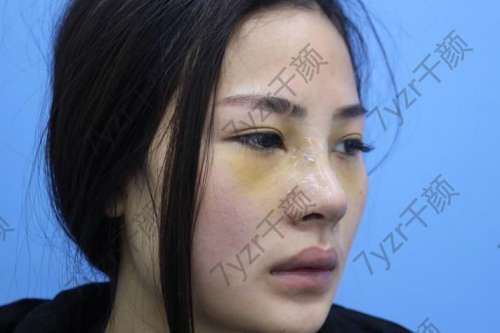 后，我下定決心做一個(gè)鼻子